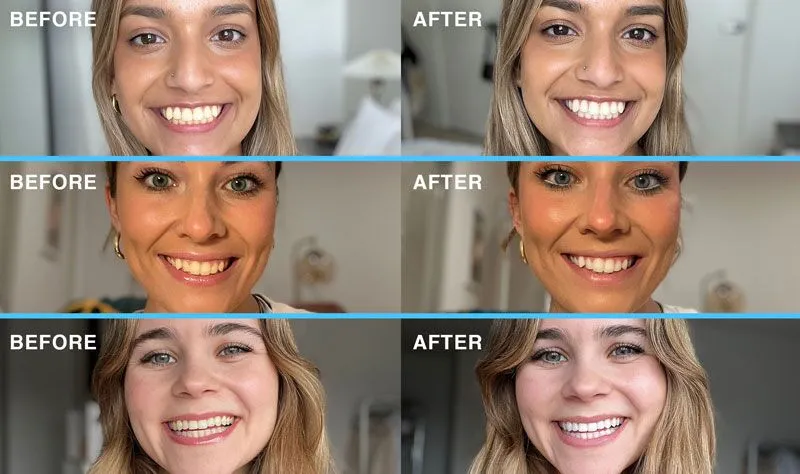 before-and-after-results-of-using-laughland-teeth-whitening-kit Best Teeth Whitening Products