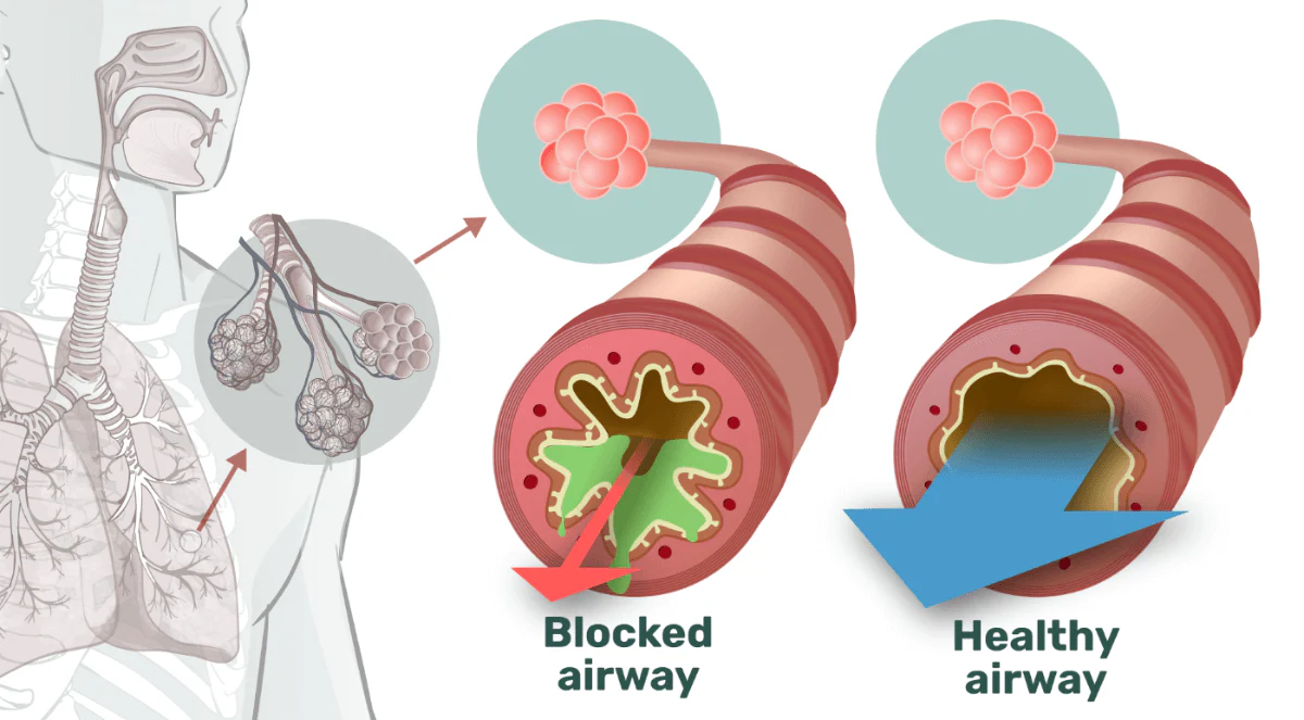 airphysio_-_airways_image_1 How to Improve Breathing & Strengthen Lungs All Naturally | AirPhysio