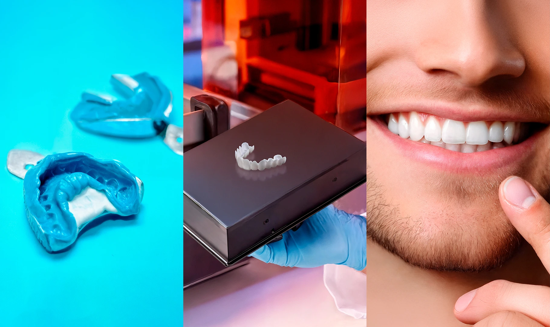 ShinySmile19 Best ​​Snap-On Veneers