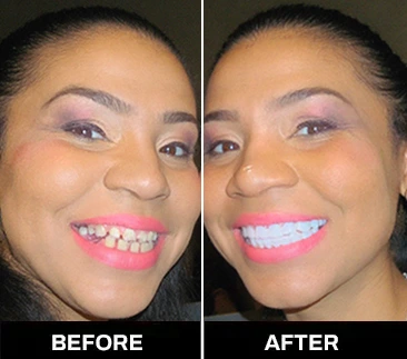 before-after-01 Best ​​Snap-On Veneers