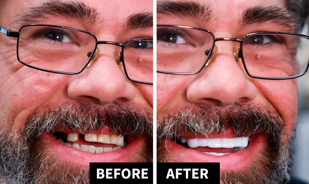 ShinySmile02-jpg Best ​​Snap-On Veneers 2026