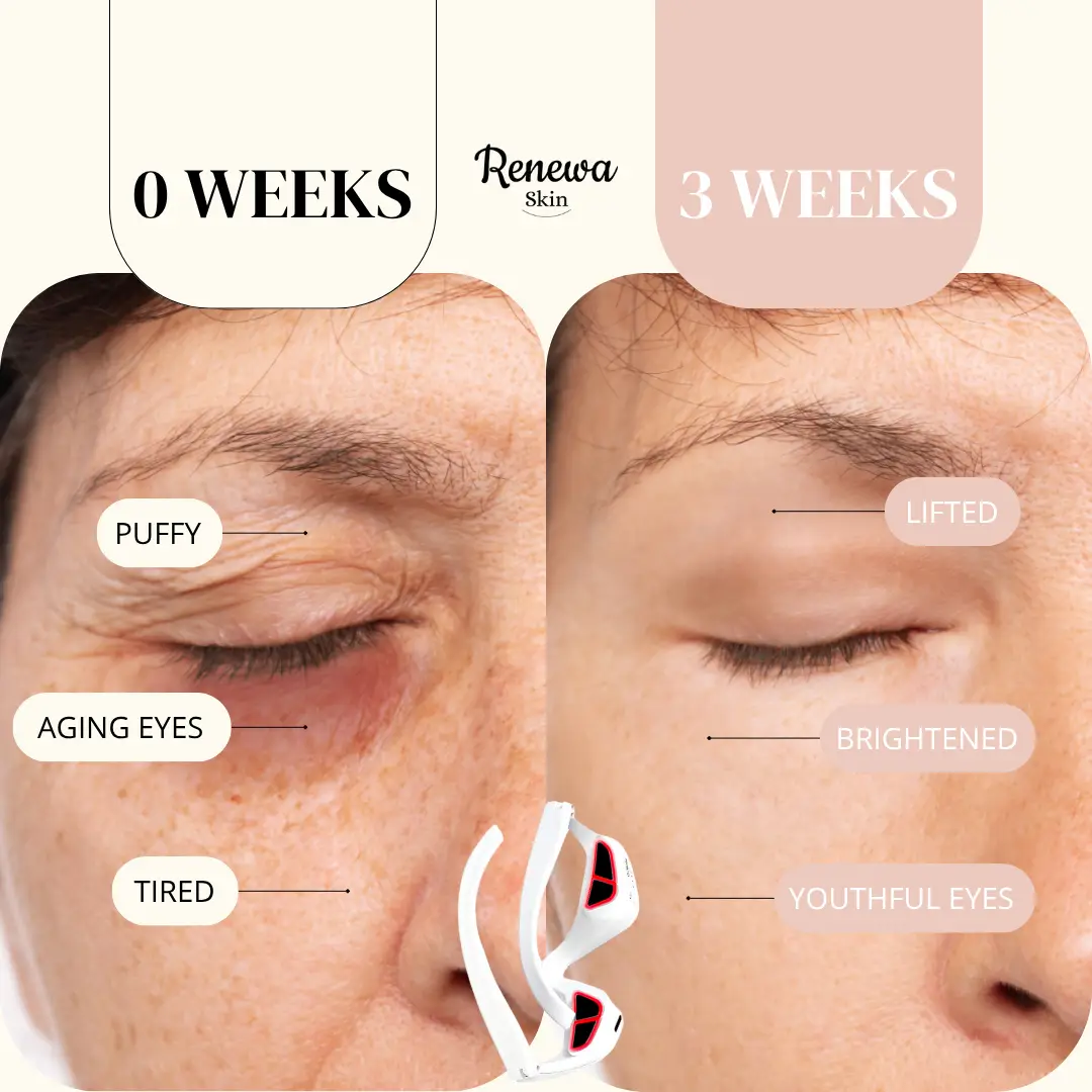 Copyof4 Best ​​​EyeLift Devices
