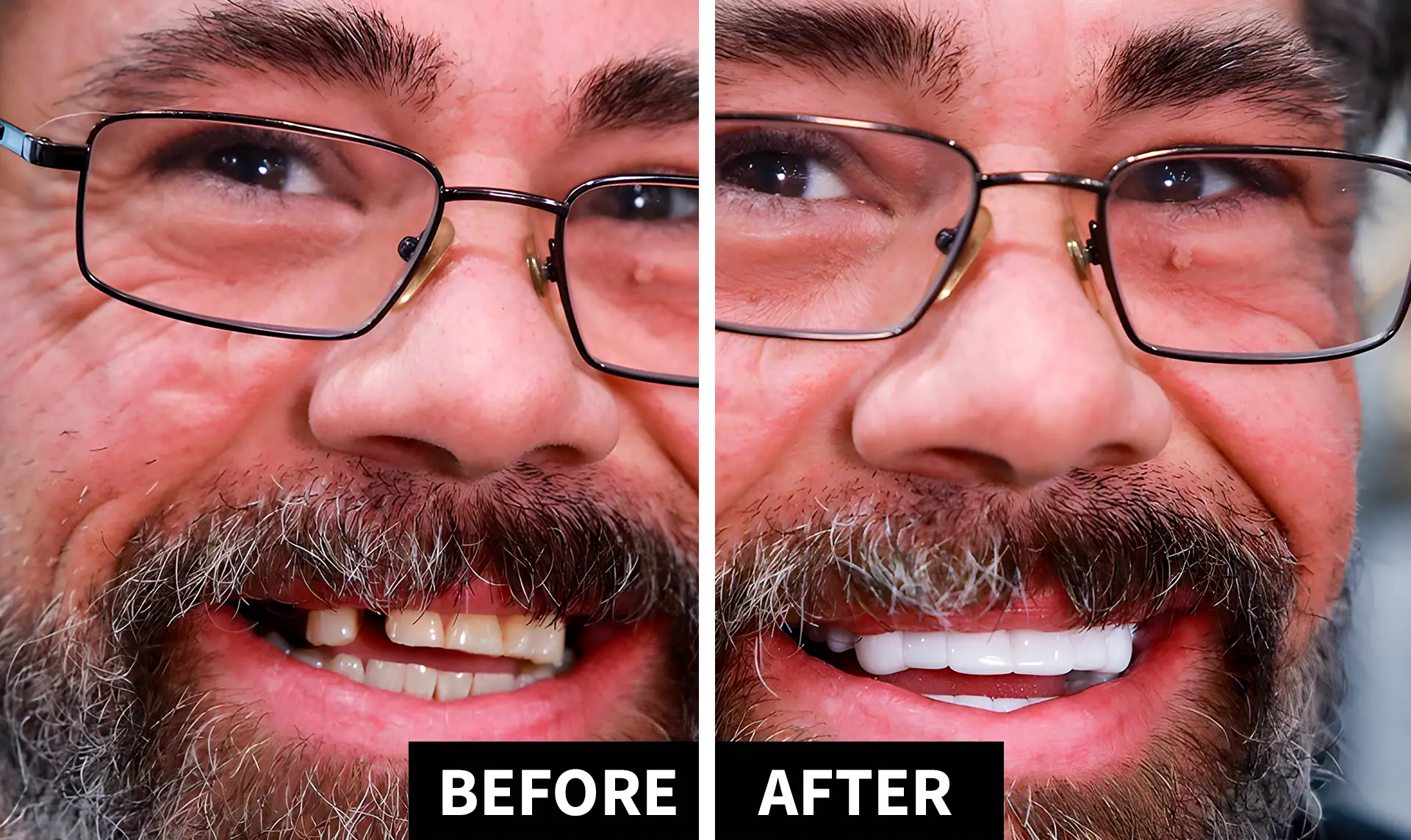 ShinySmile02 ​Snap-On Veneers Cost in 2026