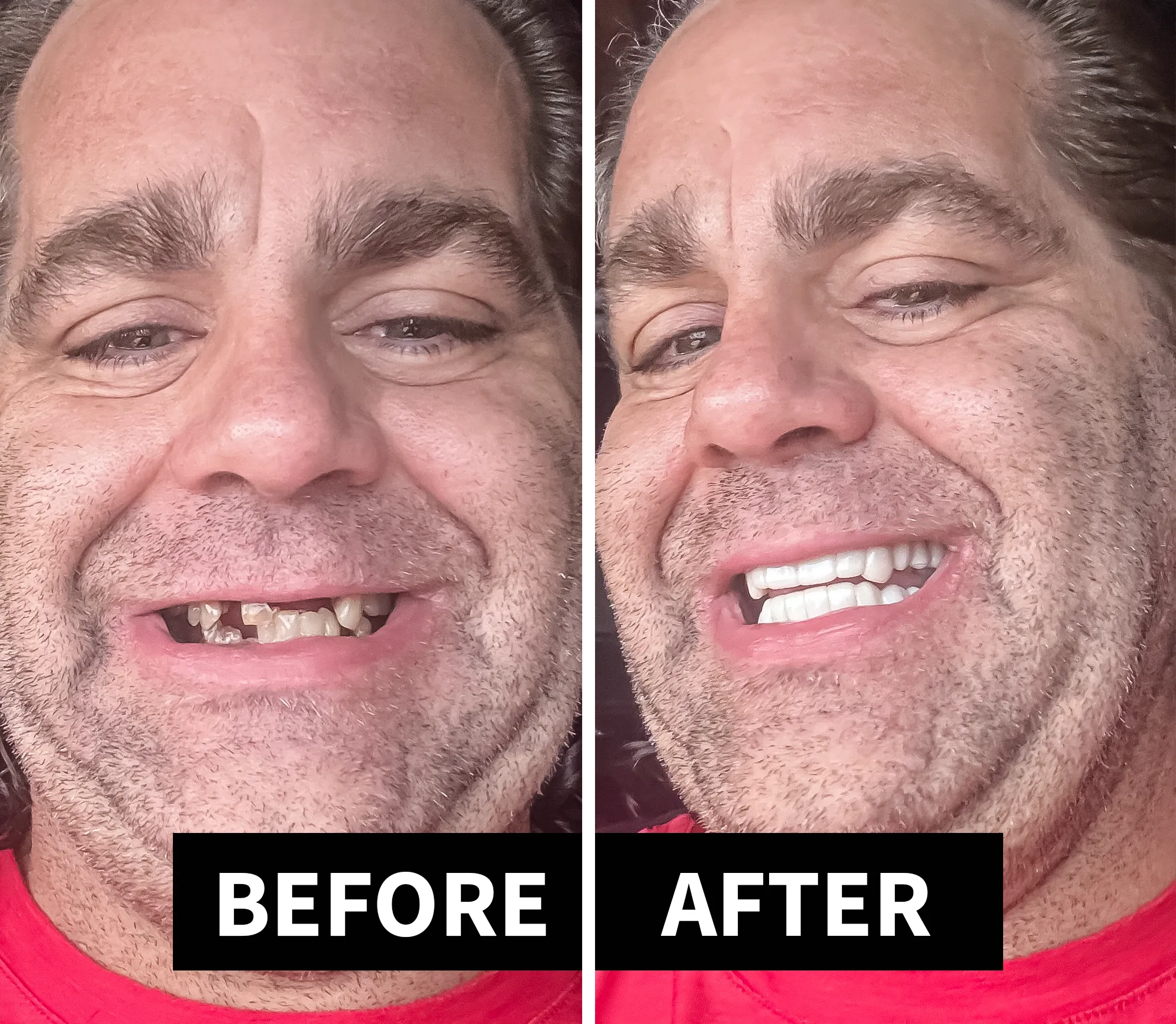 g08-png Do Snap-On Veneers Really Work? Honest Review & Before-and-After Results
